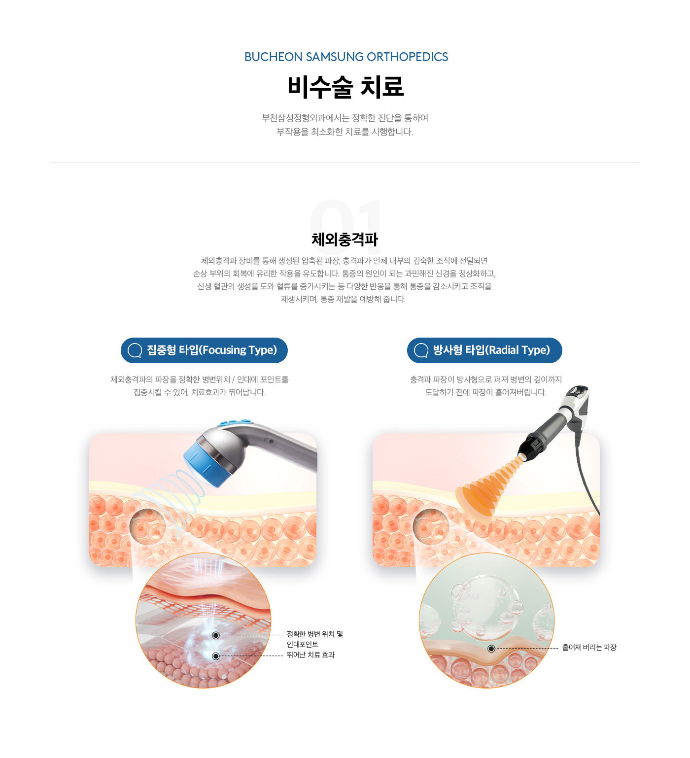 비수술 치료
